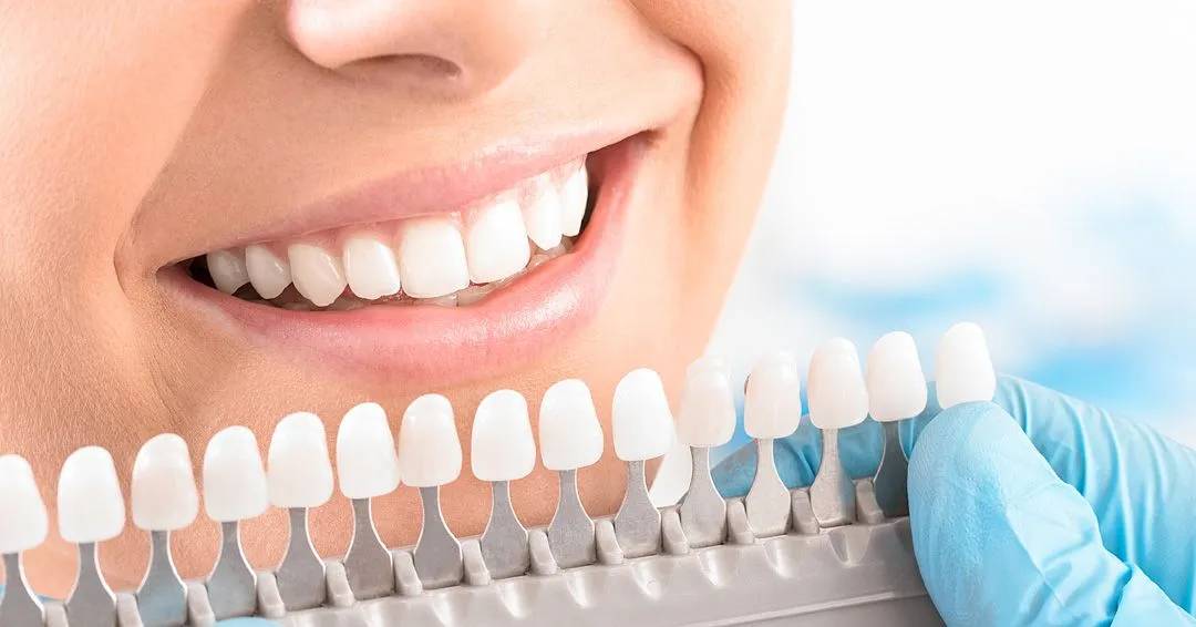 Is Professional Cleaning and Whitening Worth It?