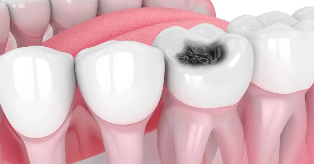 4 Signs You Have a Cavity