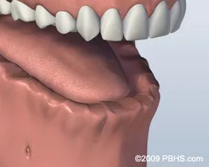 Bar Attachment Denture Before