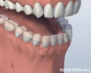 Bar Attachment Denture Denture Attached