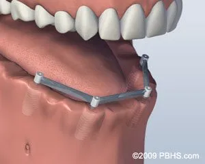 Bar Attachment Denture Implant Placed