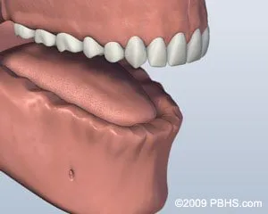 Ball Attachment Denture