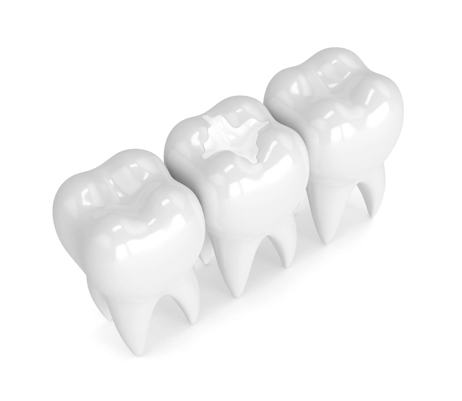 Dental Sealants