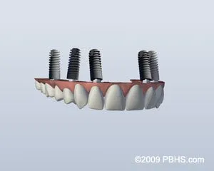 Implant Retained Upper Denture