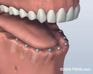 Screw Retained Denture Implant Placed