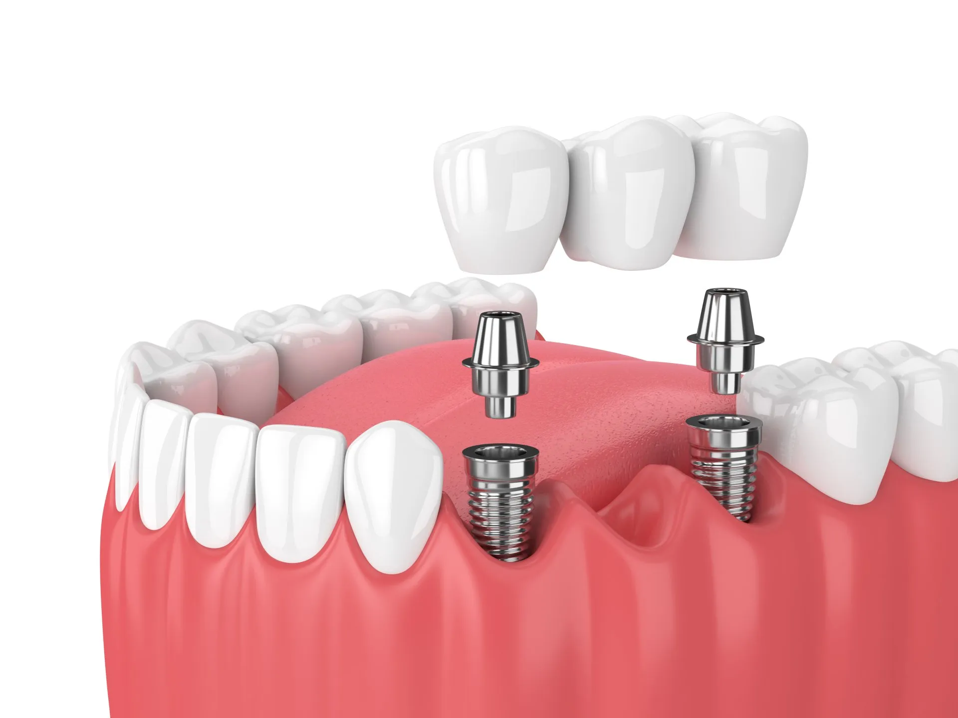 dental-implants