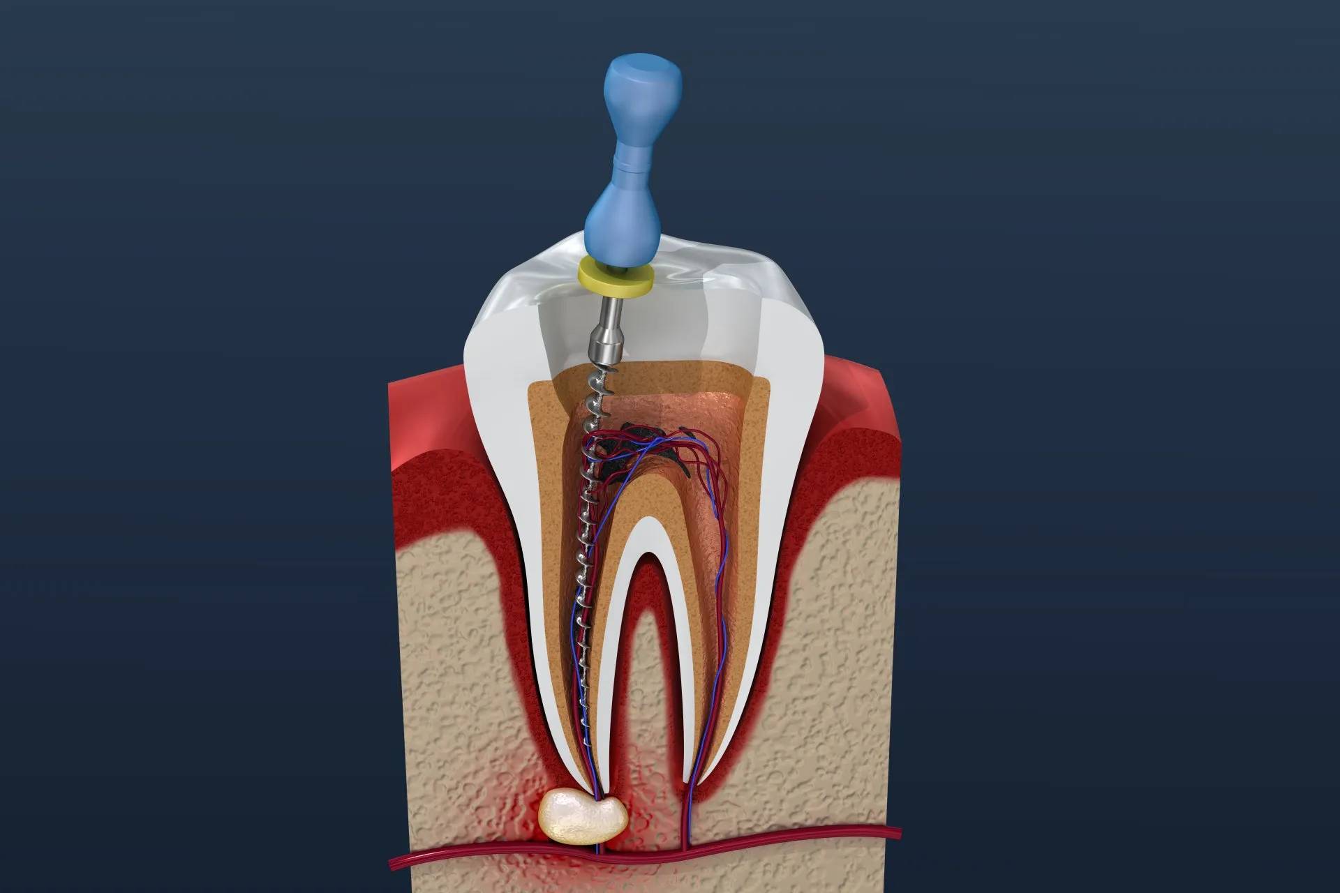 non-surgical-root-canal